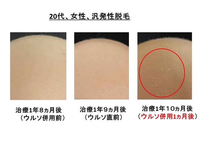 円形脱毛症　病院